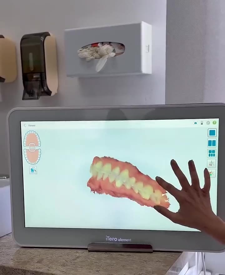 Escaneamento 3D dos dentes no scanner iTero, com o modelo da arcada na tela